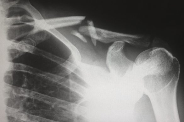 Osteoporosis
